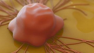 Pankreas kanseri belirtileri nelerdir, endosonografinin önemi nedir?