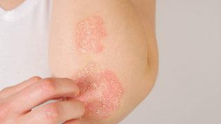 Sedef hastalığı tedavisinde akupunktur yöntemi nasıl etki eder?