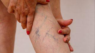 Uzman isim uyardı! Bu varis tipleri tehlikeli oluyor