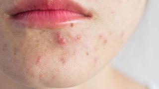 Sivilce ve akne problemi yaşayanlar dikkat! Sivilcelerin çıktığı bölgeye göre anlamları