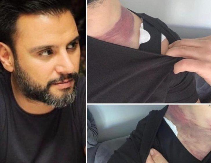 Alişan ölümden dönmüştü! Yağ aldırma davasında karar çıktı G1