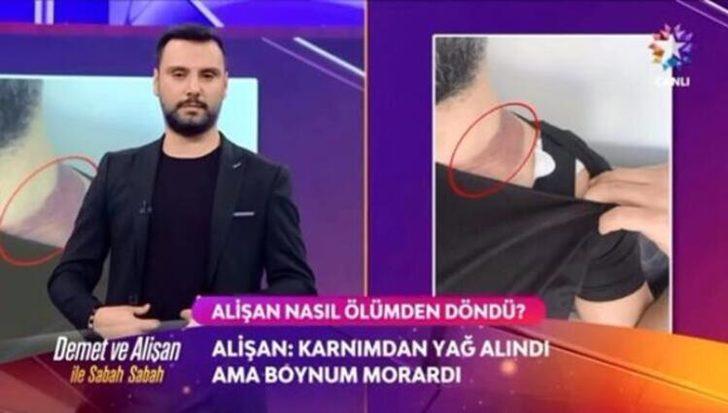 Alişan ölümden dönmüştü! Yağ aldırma davasında karar çıktı G2