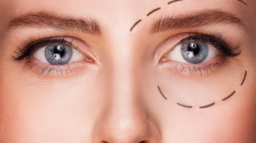 Göz kapağı estetiği nasıl yapılır? Göz kapağınızdaki sarkmalardan kurtulabilirsiniz!