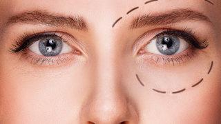 Göz kapağı estetiği nasıl yapılır? Göz kapağınızdaki sarkmalardan kurtulabilirsiniz!