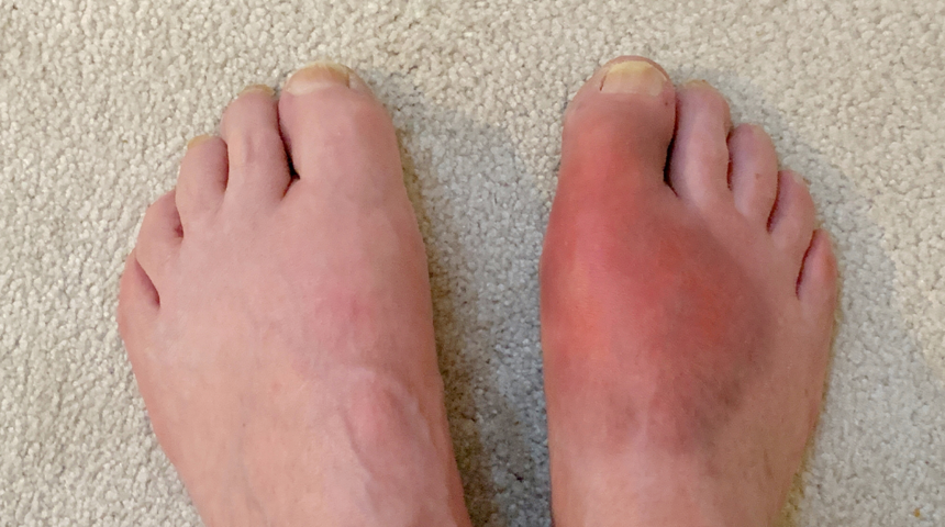 Gut hastalığı nedir? Gut hastalığı nasıl tedavi edilir? Gut hastaları hangi besinleri tüketmemeli?