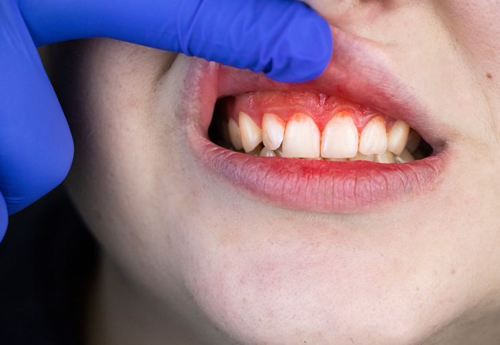 Diş kayıplarının nedeni dişeti hastalıkları