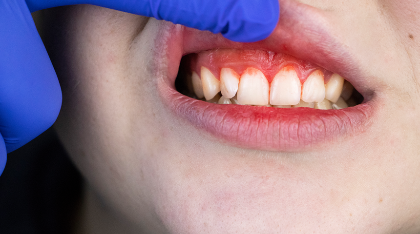 Diş etinde oluşacak hastalık belirtilerine dikkat! Diş etleriniz kanıyorsa durumu ciddiye alın