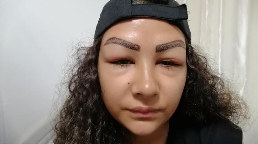 Reklam yüzü olmaya gitti, yüzünden oldu! "Aynaya bakamıyorum"