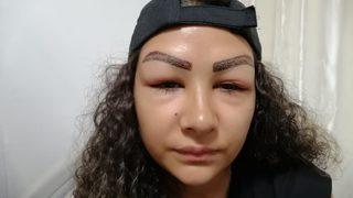 Reklam yüzü olmaya gitti, yüzünden oldu! Aynaya bakamıyorum