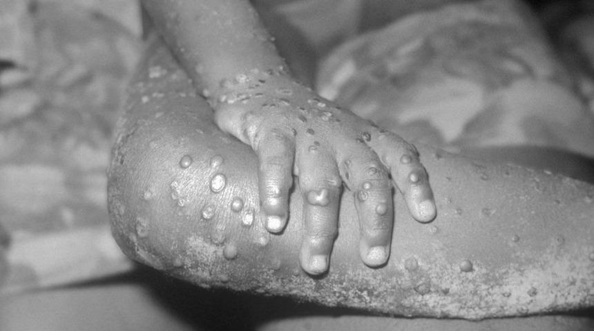 ABD'de nadir g&ouml;r&uuml;len, maymun &ccedil;i&ccedil;eği vir&uuml;s&uuml; nedeniyle 200 kişi takip altında