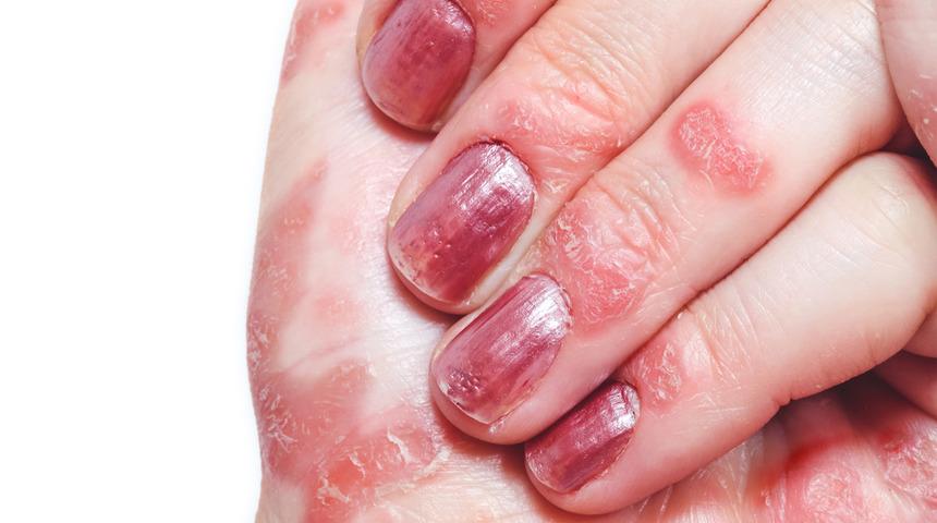 Egzama nedir, ne iyi gelir? İşte egzama sorununu ortadan kaldıracak yöntemler