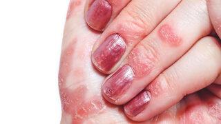 Egzama nedir, ne iyi gelir? İşte egzama sorununu ortadan kaldıracak yöntemler