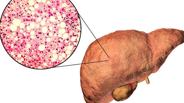 İç organ yağlanması nasıl eritilir? İç organ yağlanmasını kontrol altına almak için...
