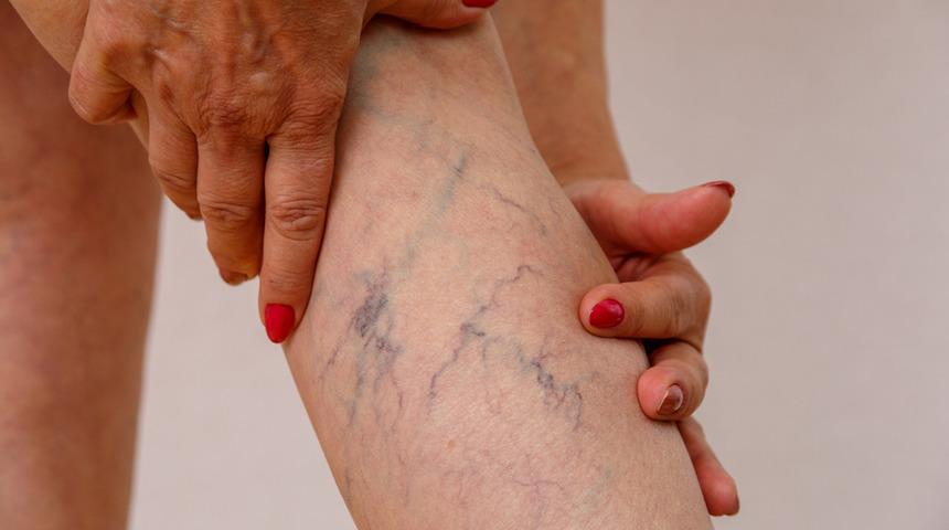 Varis tedavi edilebiliyor