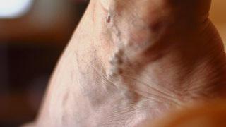 Varis tedavi edildikten sonra tekrarlar mı?