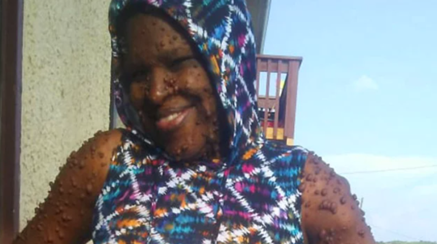 Sahip olduğu nadir bir genetik hastalık yüzünden vücudunda 200’den fazla tümör bulunan kadın şaşırttı