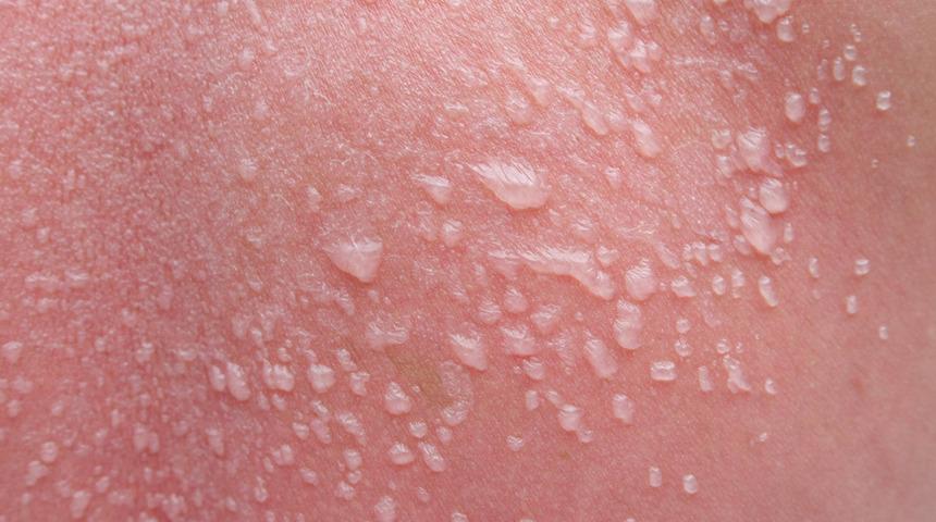 Güneşlenme uyarısı: Kanser riskini arttırıyor! Su toplanması görülüyorsa...