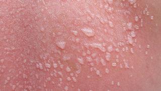 Güneşlenme uyarısı: Kanser riskini arttırıyor! Su toplanması görülüyorsa...