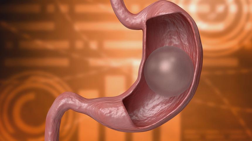 Mide balonu obezite tedavisinde kullanılabilir mi?