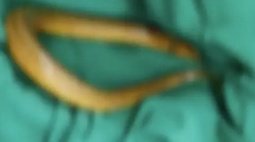 Çin'de akıllara durgunluk veren olay! Anüsüne 20 santimetrelik yılan balığı soktu