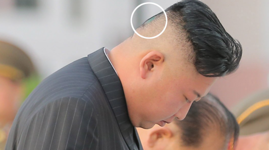 Kuzey Kore lideri Kim Jong-Un son görüntüsüyle konuşuluyor! Kafasının arkası çürüdü iddiası