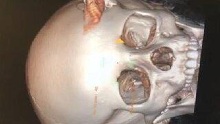 Başında kurşunla 75 gündür yaşam savaşı veriyor