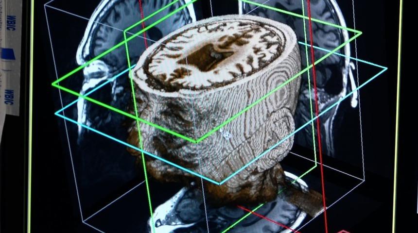 Yapay zeka, demans hastalığını 'bir g&uuml;nde tespit edebilir'