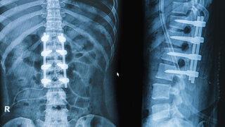 Omurga ameliyatlarında vida ne zaman kullanılmalıdır?