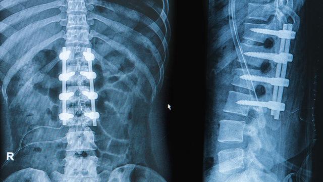 Omurga ameliyatlarında vida ne zaman kullanılmalıdır?
