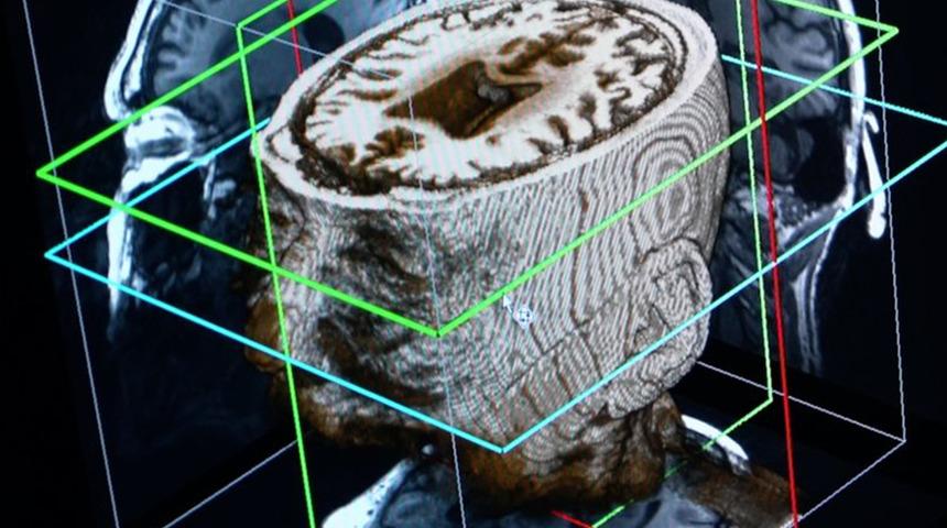 Demans (bunama) hastalığı teşhisinde devrim niteliğinde buluş! Yapay zeka ile 1 günde tespit edilecek