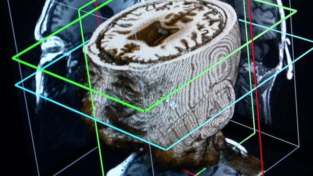 Demans (bunama) hastalığı teşhisinde devrim niteliğinde buluş! Yapay zeka ile 1 günde tespit edilecek