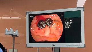 Karnındaki ağrıyı gaz sancısı sandı, safra kanalından çıkanlar şaşkına çevirdi