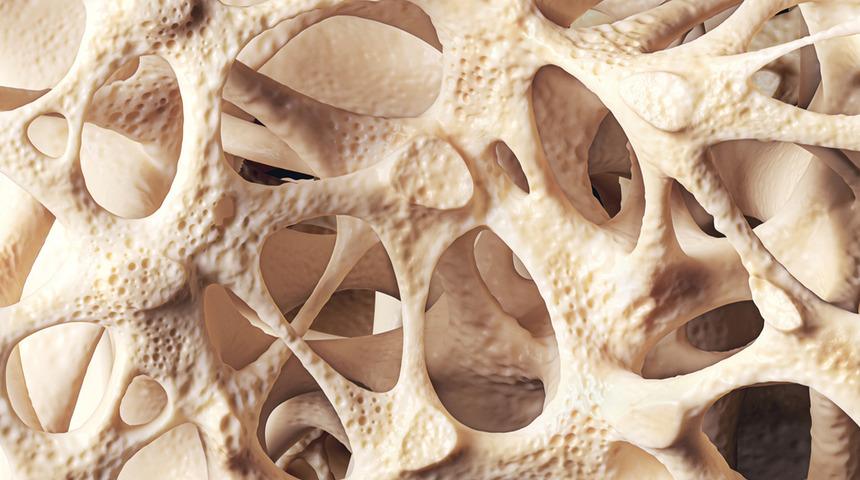 Osteoporoz nedir? Korunmak için yapmanız gerekenler