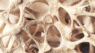 Osteoporoz nedir? Korunmak için yapmanız gerekenler