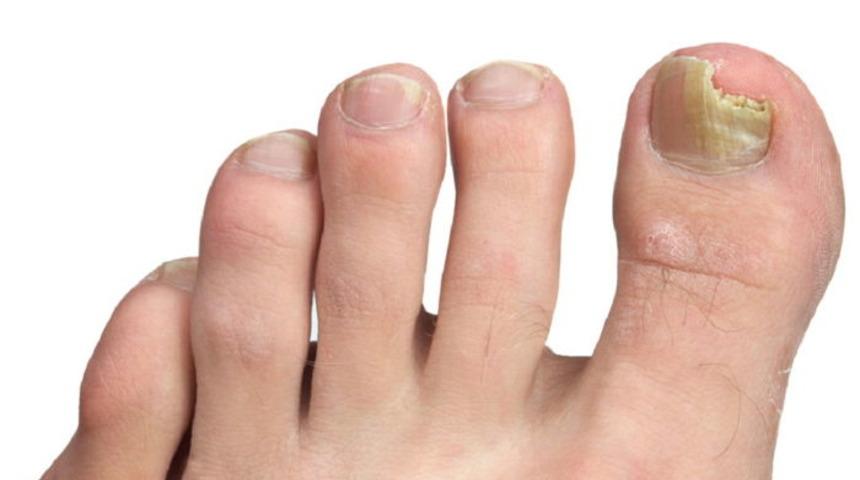 Mantar hastalığının önüne geçmek artık mümkün