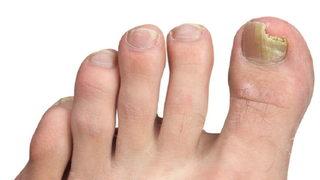 Aşırı terleme mantara yol açıyor