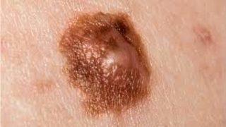 Benler kötü huylu tümöre dönüşebiliyor