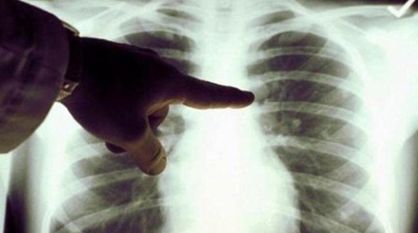 Türkiye'de verem hastalığı artıyor