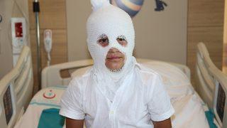 Arkadaşının yaktığı kolonyayı söndürürken yanan çocuk Erzurum'da tedaviye alındı