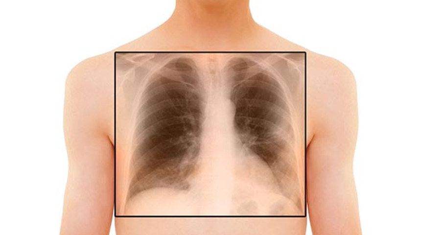 Yeni bir akciğer hastalığı: BOOP