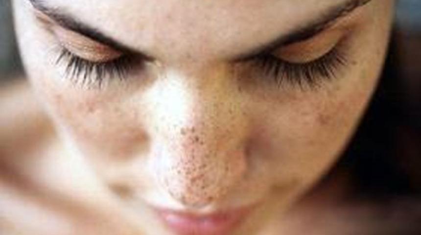 Yaz Lekelerinden Kurtulun