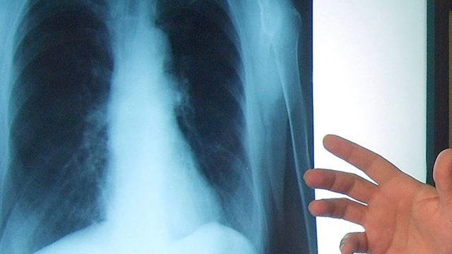 En sık görülen belirtisi öksürük! Uzman isimden akciğer kanseri uyarısı
