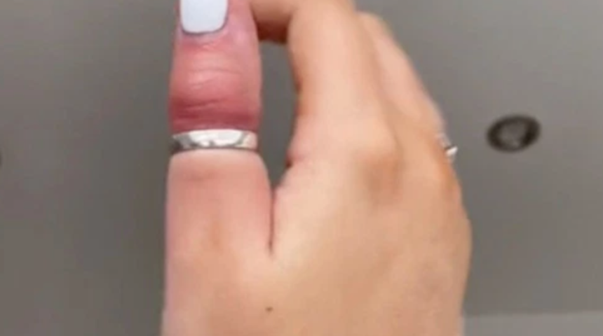 Yüzükle uyuduğu için parmağını kırdığını söyleyen TikTok kullanıcısı deneyimini paylaştı