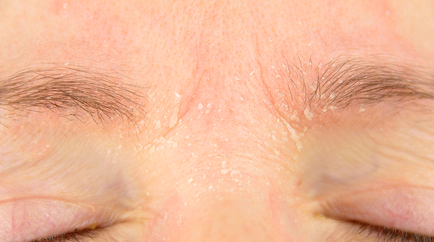 Yaz aylarında kuruyan ciltlere bakım önerileri! Pul pul dökülüyorsa bu tavsiyelere kulak verin