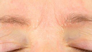 Yaz aylarında kuruyan ciltlere bakım önerileri! Pul pul dökülüyorsa bu tavsiyelere kulak verin