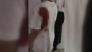 İstanbul'da korkunç olay! Sırtındaki acıyı çivi sandı, içinden mermi çıktı