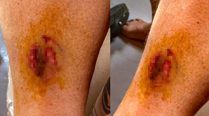 Göcek'te denize giren kadına büyük şok! Caretta caretta ısırdı