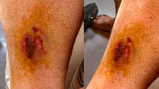 Göcek'te denize giren kadına büyük şok! Caretta caretta ısırdı