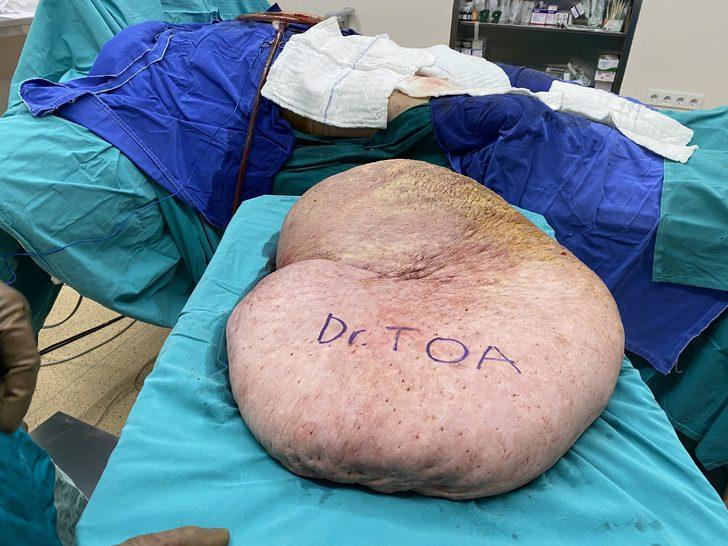 İnanılmaz görüntü! Bedeninden tam 35 kiloluk kitle çıktı G1