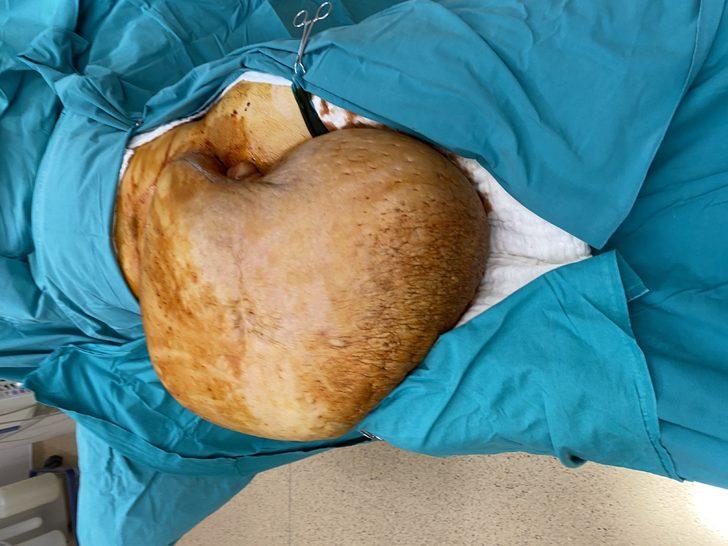 İnanılmaz görüntü! Bedeninden tam 35 kiloluk kitle çıktı G3